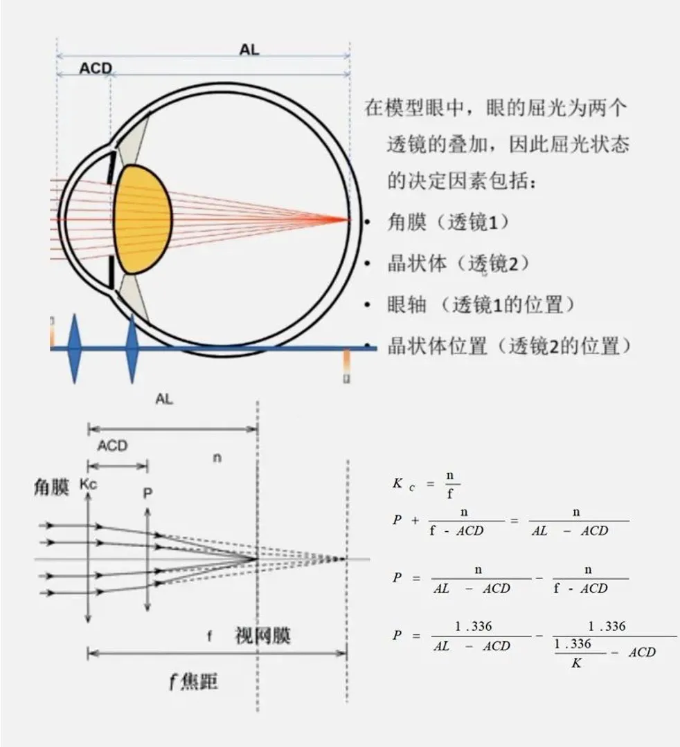 传统人工晶状体计算